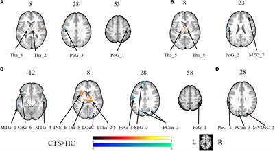 Dysfunction in the Interaction of Information Between and Within the Bilateral Primary Sensory Cortex